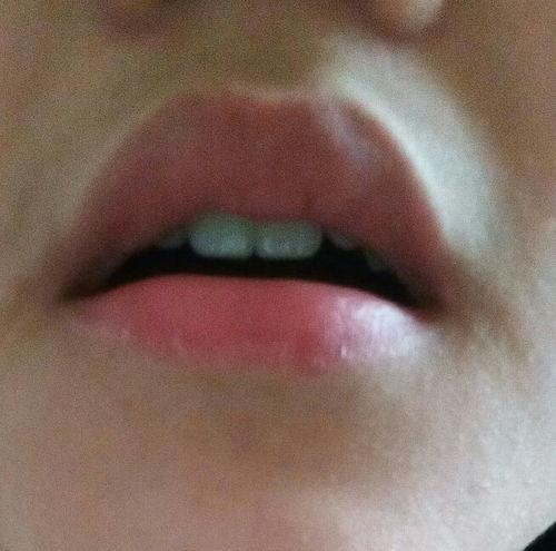 上嘴唇外翻图片,成因、影响及矫正之道